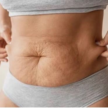 15 sessions Focused Skin Tighten at Sculpted Body Renewal in Villa Rica, GA
